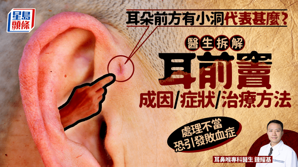 耳朵前方有小洞代表甚么？医生拆解耳前窦成因/症状/治疗方法 处理不当恐引发败血症