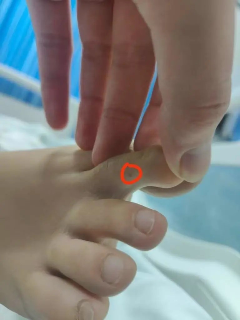 李甜甜的腳部被蛇咬後留下的創口。抖音 李甜甜的腳部被蛇咬後留下的創口。抖音