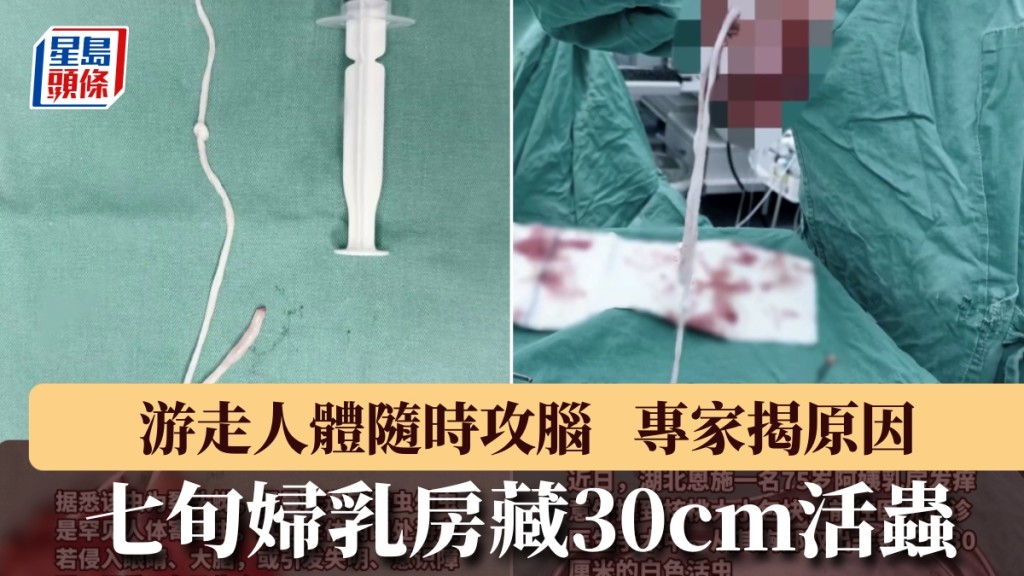 七旬妇乳房藏30cm活虫，游走人体随时攻脑，专家揭原因。