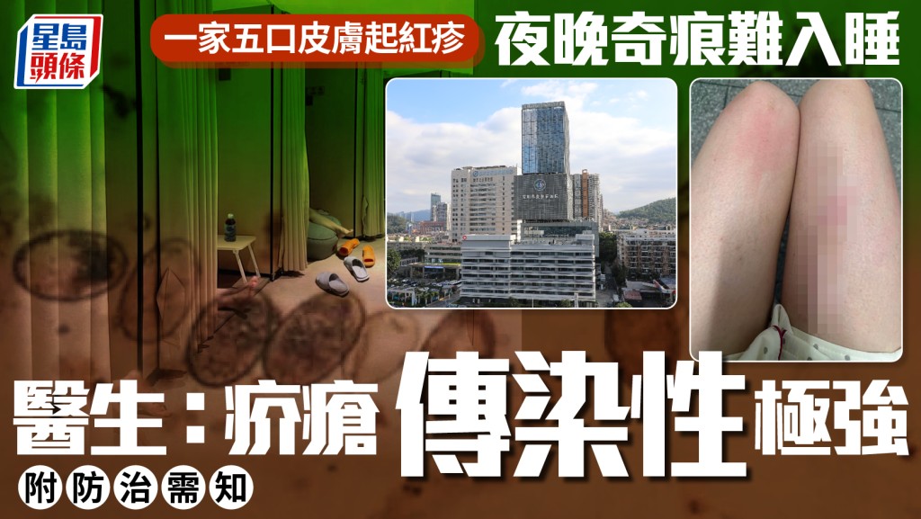 不是濕疹︱深圳一家五口患疥瘡夜晚奇痕難入睡   醫生警告：傳染性極強
