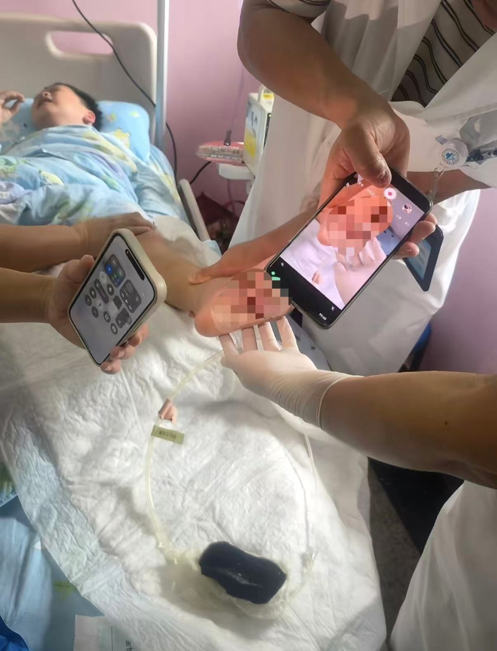 6歲男童沙灘赤腳踩到死魚被扎傷,高燒昏迷險截肢。抖音@路過的風景 6歲男童沙灘赤腳踩到死魚被扎傷,高燒昏迷險截肢。抖音@路過的風景