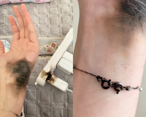 上海一名女子在家拔掉電腦插頭時突然發生爆炸,戴在手上的手鏈斷了,手掌亦被熏黑。網圖