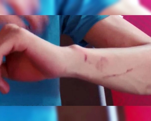 長沙有學生遊玩密室逃脫後，手臂上全是傷。網圖