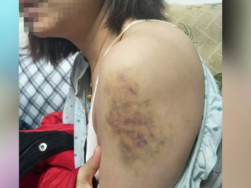 女子稱已經被家暴了16年,每次都被打的渾身是傷,青一塊紫一塊。(網圖)