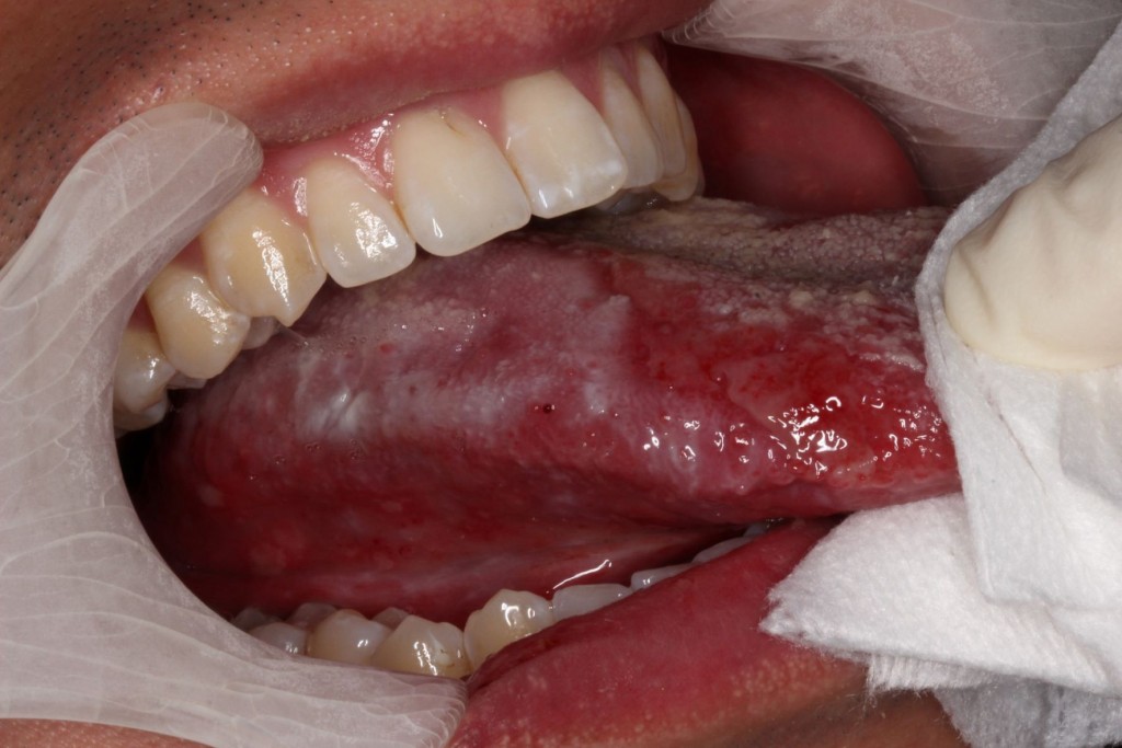 病人患有舌类扁平苔藓黏膜炎。港大图片