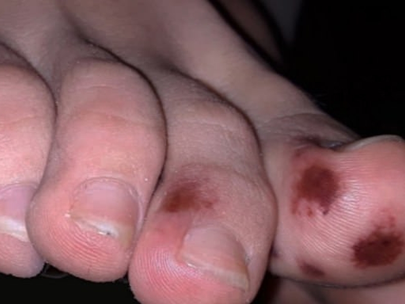 西班牙一個醫療研究小組表示,類似於水痘的腳趾疼痛可能是新冠病毒的一種新的特殊症狀。(網圖)