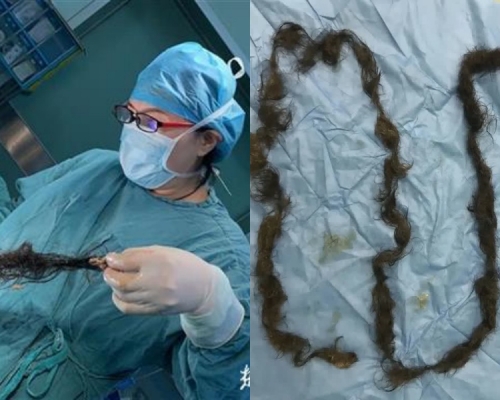 醫生在畸胎瘤拉出長達兩米多的毛髮。網圖