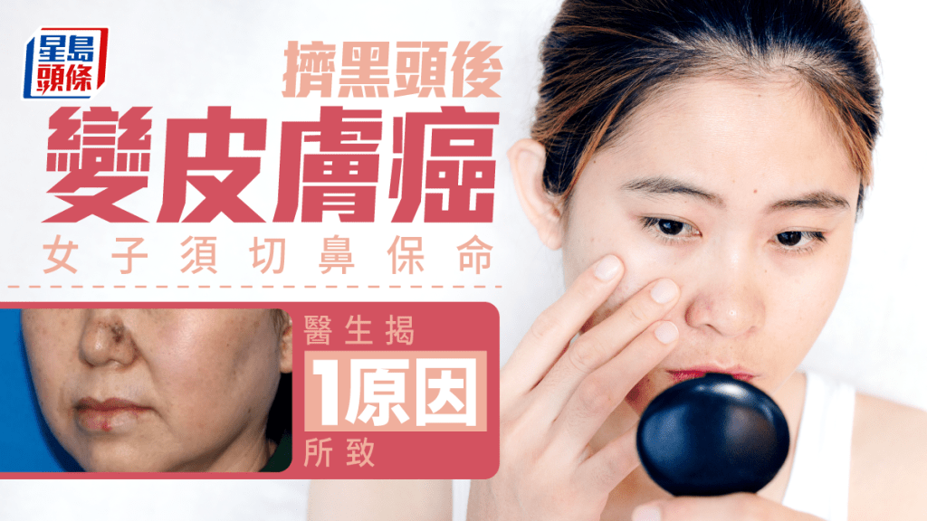 女子鼻上生黑頭竟是皮膚癌徵兆,終須切鼻保命。