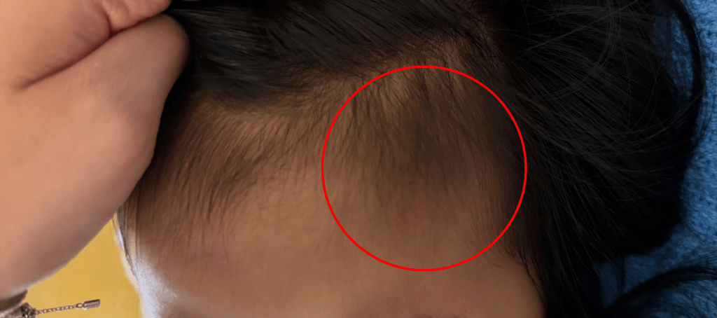 女童的額頭亦出現明顯瘀痕。胡小姐提供