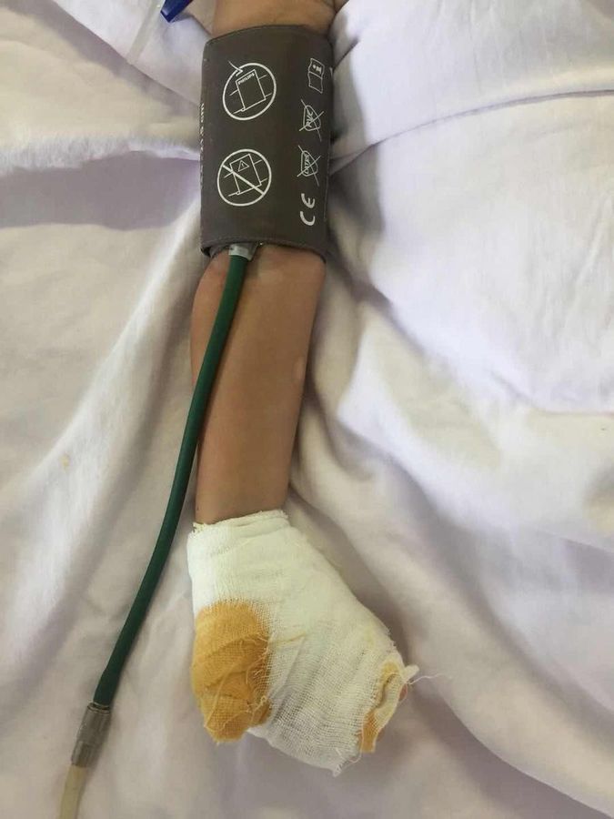 醫生指女童左手損傷非常嚴重。網圖