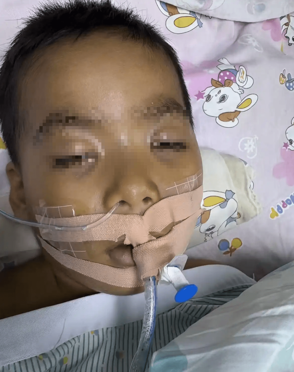  廣東3歲男童切扁桃腺術後腦死亡，意識微弱已昏迷半個月。