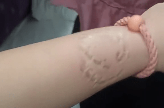 女事主被咬伤后，手臂留下明显的牙印。