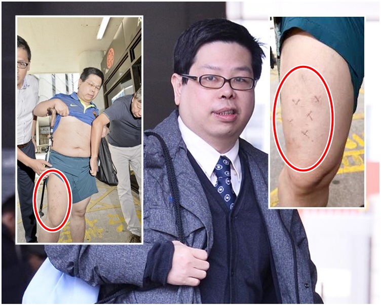 林子健出庭。小圖為雙腿釘上的十字釘書釘。資料圖片