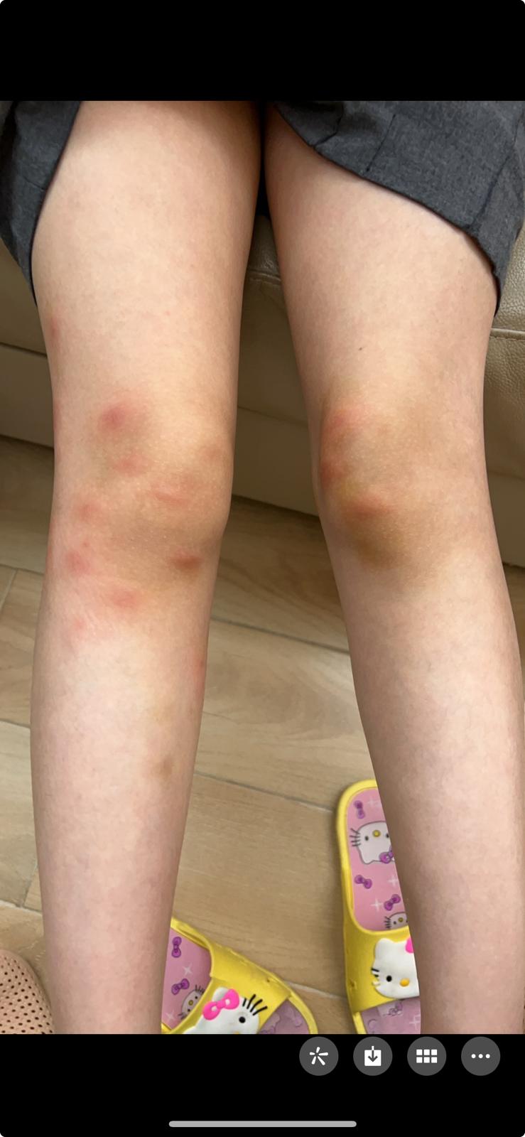 當基孔肯雅熱患者被病媒蚊叮咬後，病媒蚊便可能受到感染，若再叮咬其他人，便有機會將病毒傳播。資料圖片