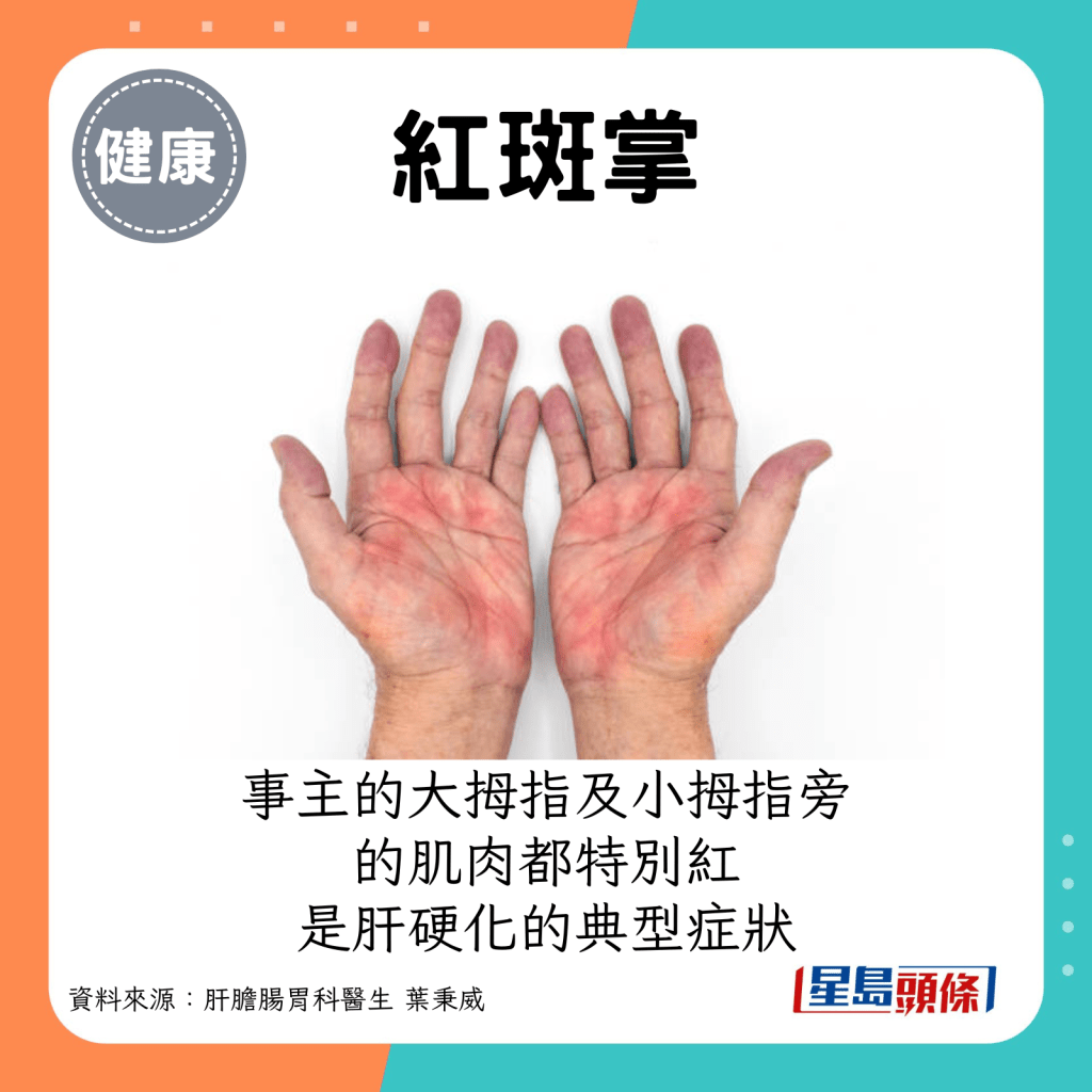 事主的雙手大拇指及小拇指旁的肌肉都特別紅，是肝硬化的典型症狀。