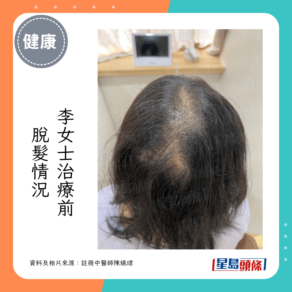 李女士產後脫髮，接受中醫治療前頭頂部分位置光禿