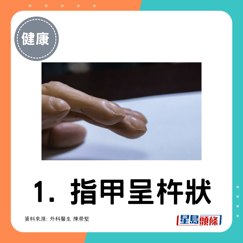 1. 指甲呈杵狀