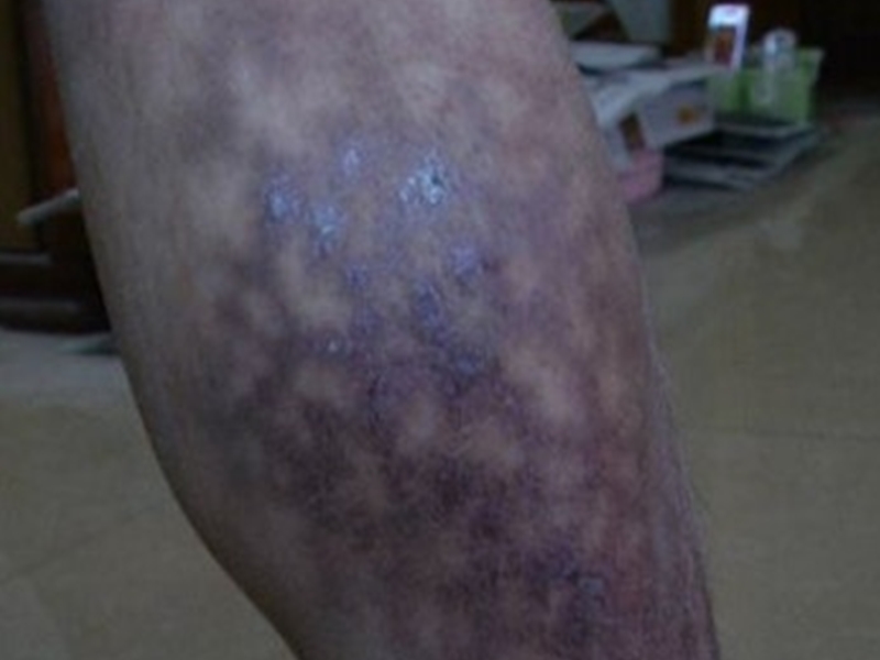 魏先生的小腿、雙腳被燙傷。網圖