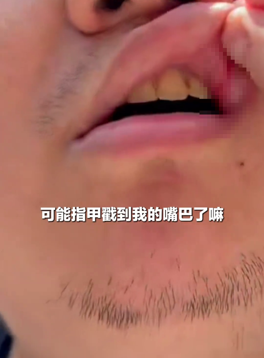 記者展示傷情。 中國新聞網 記者展示傷情。 中國新聞網