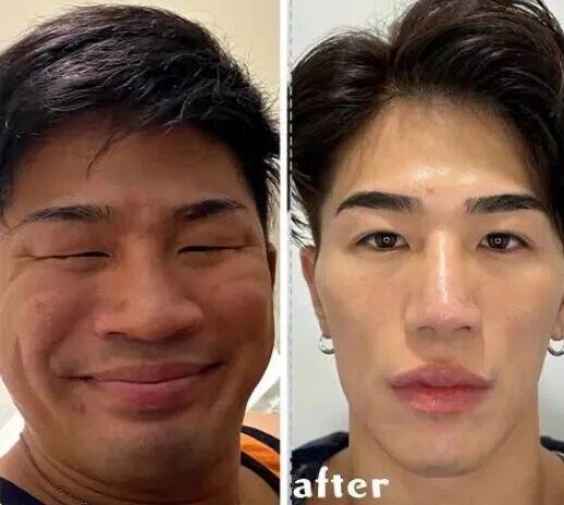 日丑男被骂“猪狒狒”饱受欺凌,狂操肌兼整容逆袭成“神户型男”。 日丑男被骂“猪狒狒”饱受欺凌,狂操肌兼整容逆袭成“神户型男”。