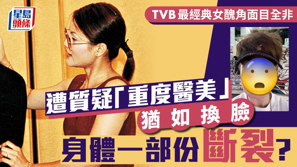 TVB「最經典女醜角」面目全非  遭質疑「重度醫美」猶如換臉  身體一部份斷裂令人憂心