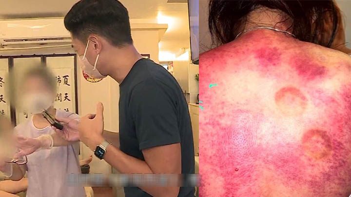 《東張西望》報道屯門一間按摩店有技師為客人拔火罐，因失誤導致客人頸背被燒傷。