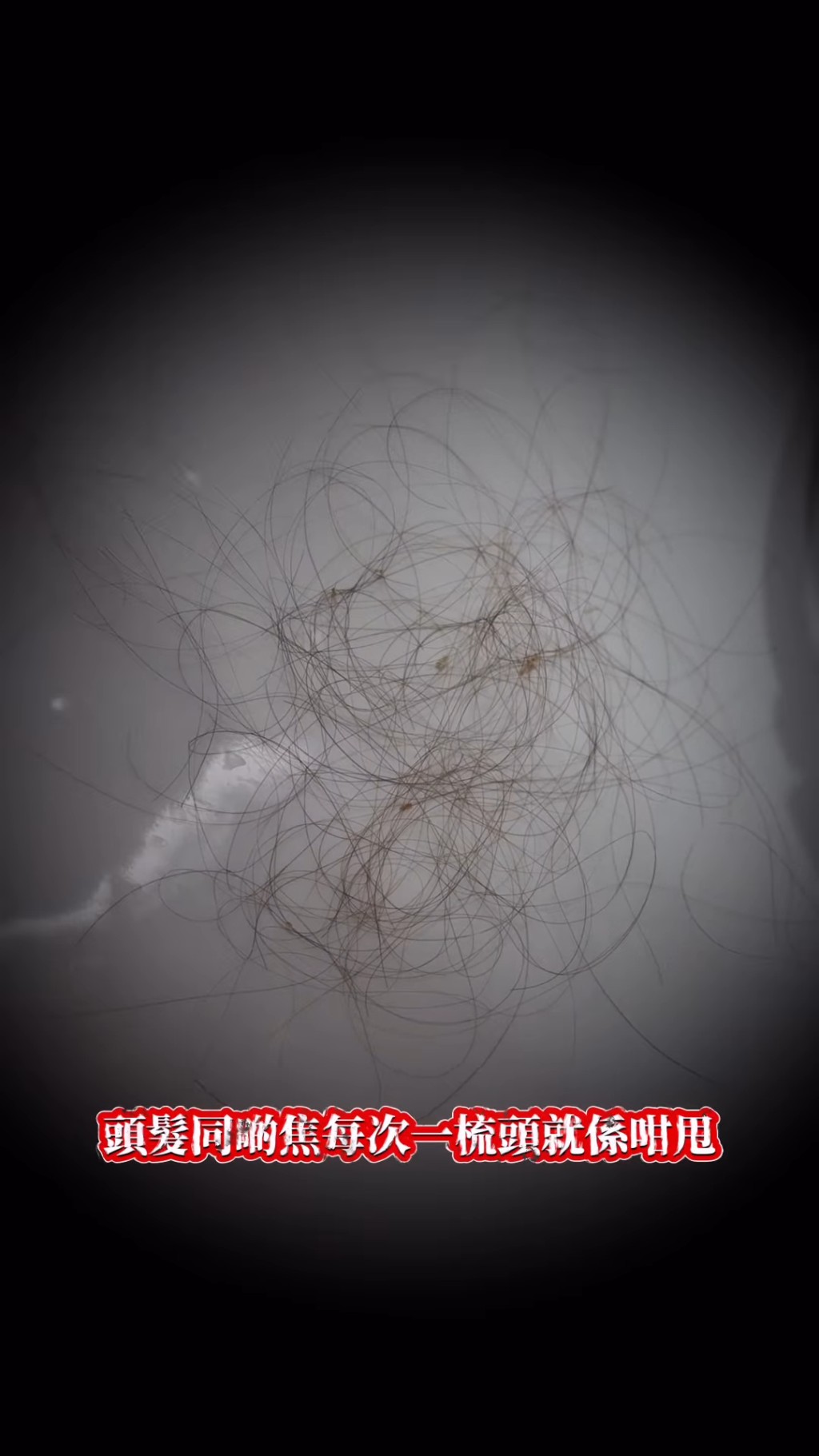 五索指每次梳頭,大量頭髮都會伴著傷口的焦掉落。 五索指每次梳頭,大量頭髮都會伴著傷口的焦掉落。