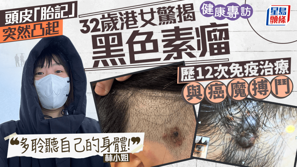 32岁港女头皮「胎记」突然凸起 确诊第三期黑色素瘤 拒悲观在Threads记录抗癌日记：多聆听自己的身体！｜健康专访
