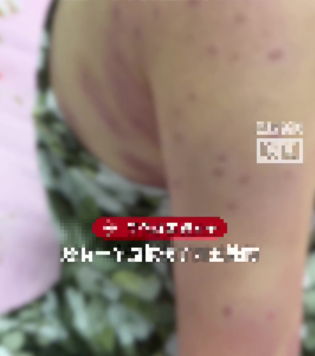 女子玩高空鋼索遭蜂群圍攻，慘螫180針休克命懸半空險死。 荔枝新聞