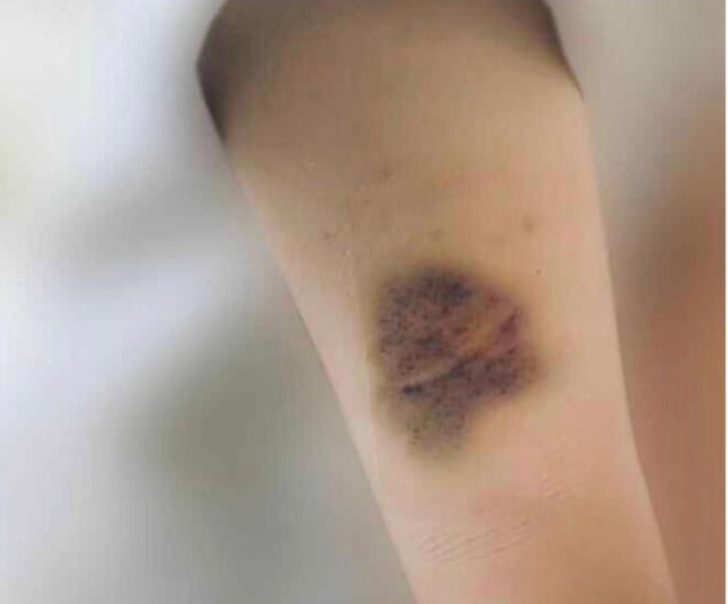 小澤廉的前度A小姐公開自己傷勢。