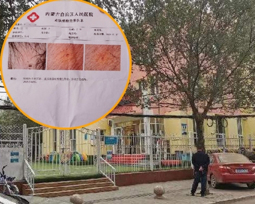 內蒙一間幼兒園多名孩童身上現針眼,警方將三名涉事老師刑拘。(網圖)