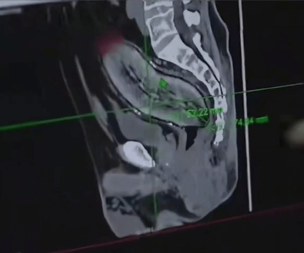塞入肛门的番薯,长约17cm、直径6-7cm。 塞入肛门的番薯,长约17cm、直径6-7cm。