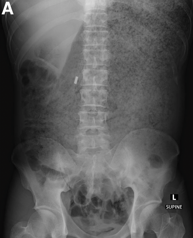 X光片顯示，男子腹部呈繃緊且膨脹狀態。《Gastroenterology》