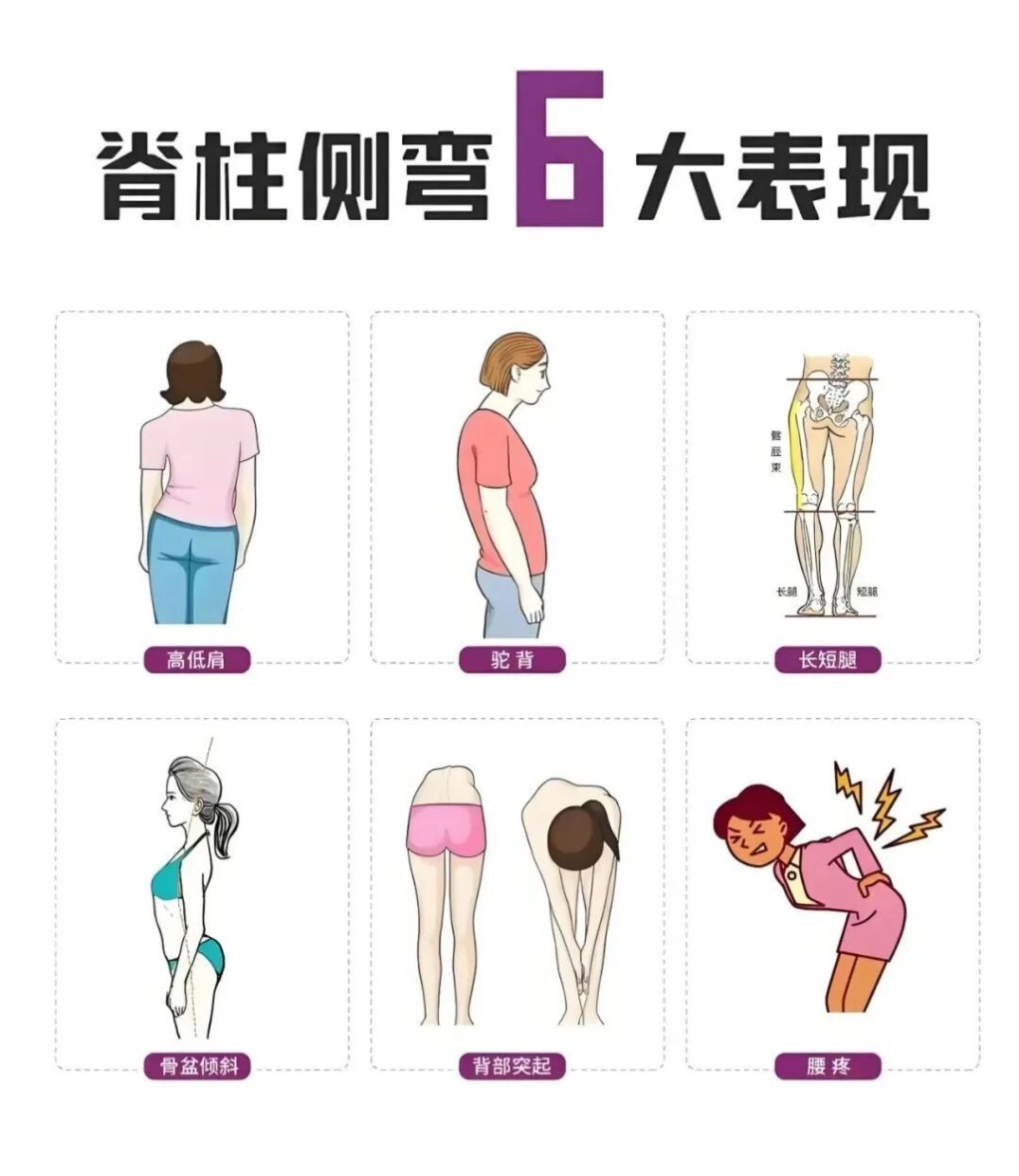 脊柱側彎6大表現。圖片由筆者提供