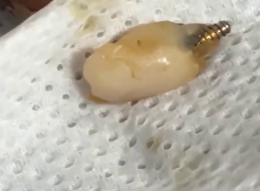 這顆牙齒狀異物,一端有帶螺紋的金屬狀部件。 這顆牙齒狀異物,一端有帶螺紋的金屬狀部件。