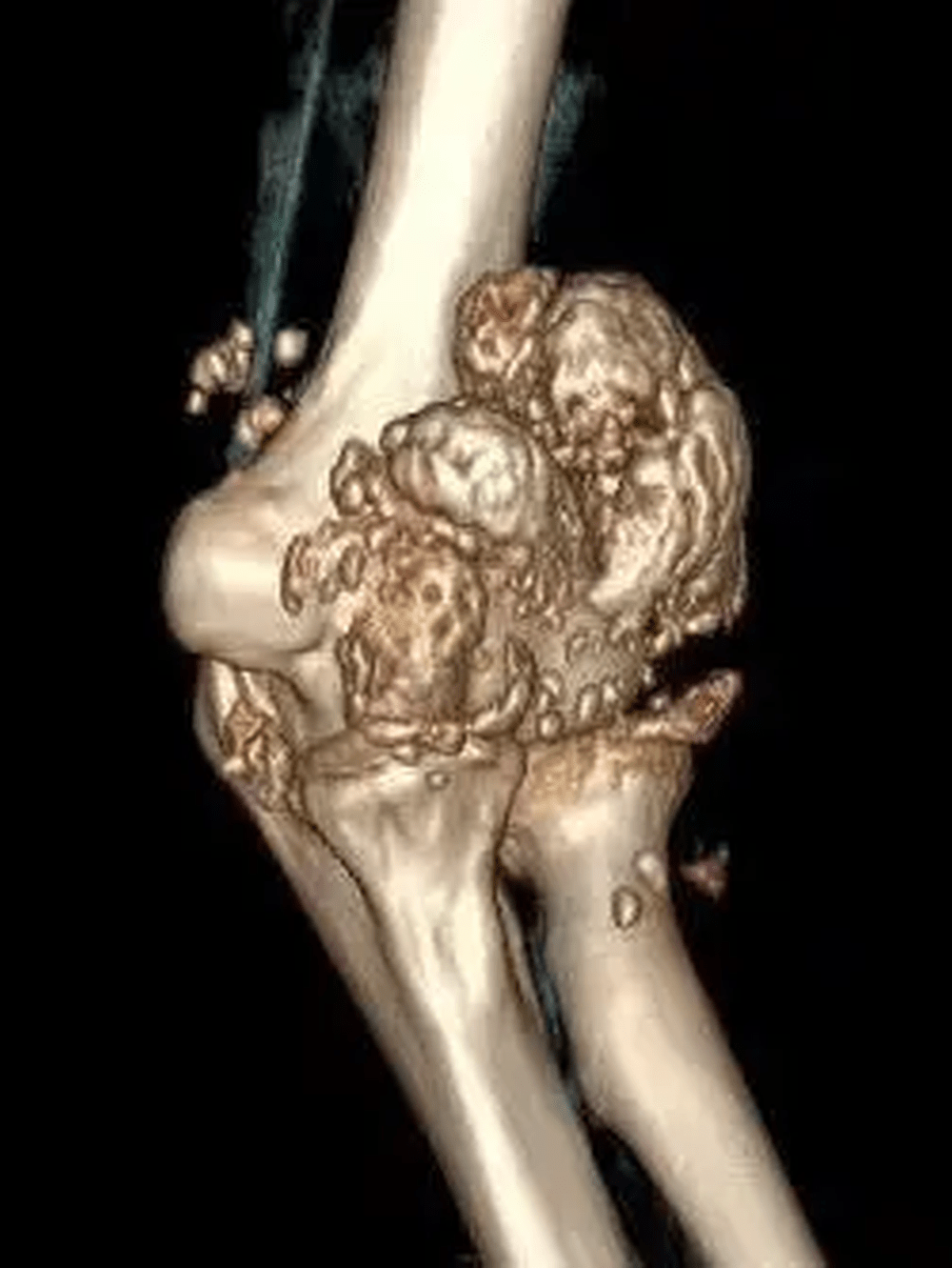 病人的手肘關節內居然長出千餘顆「珍珠」狀顆粒。