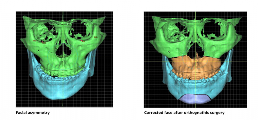 正顎手術矯正面部不對稱。港大圖片