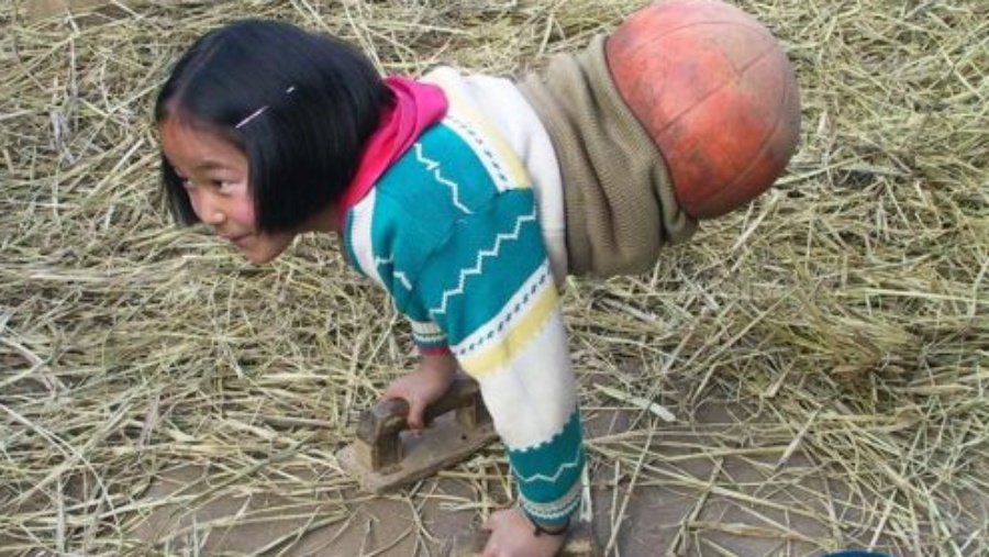 钱红艳小时靠爷爷给她造的特制篮球拄著木手垫挪动身体。