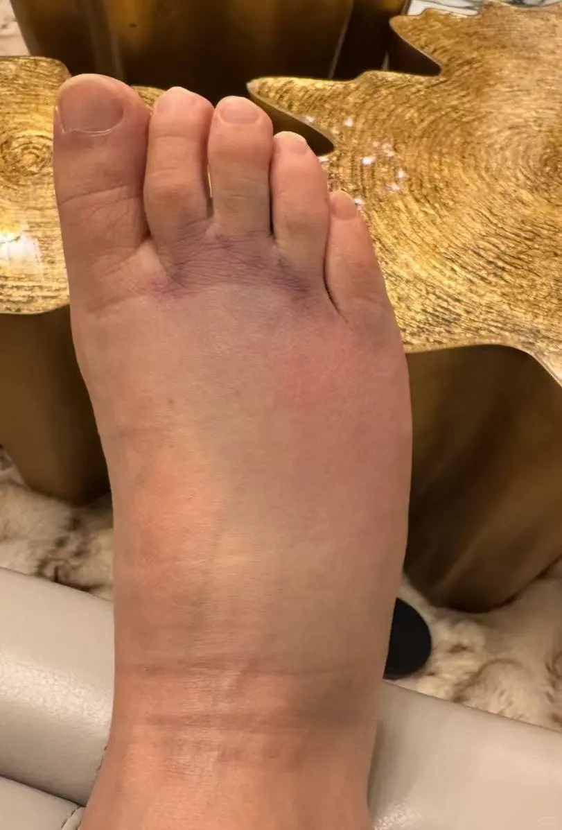 可惜近日他於家中發生意外,撞爆了腳骨,起了「雞蛋般大腫瘤」。 可惜近日他於家中發生意外,撞爆了腳骨,起了「雞蛋般大腫瘤」。