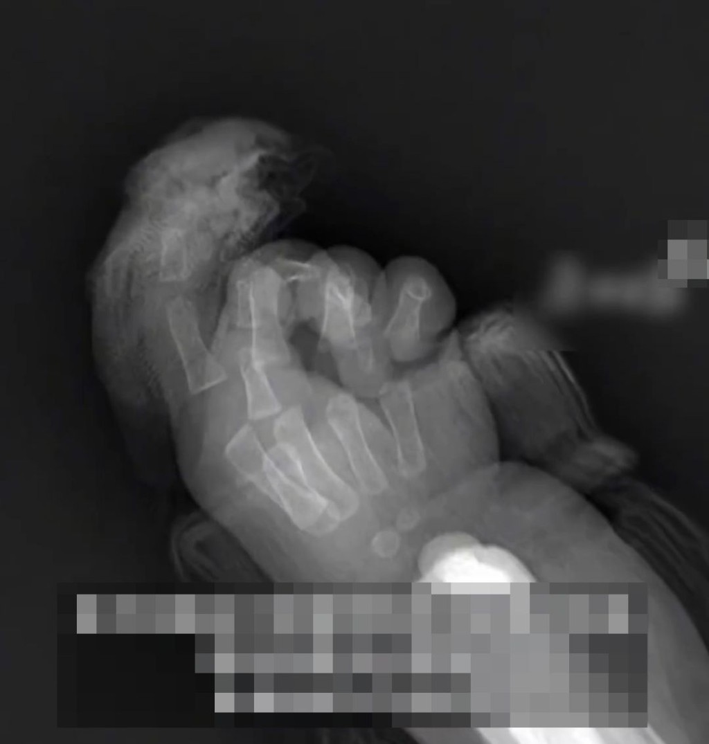 粗心妈用铰剪拆包裹，切断7个月大B女手指。《齐鲁晚报》