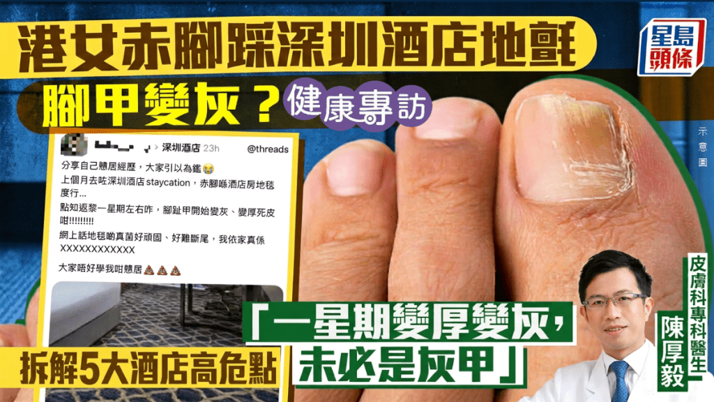 港女赤腳踩深圳酒店地氈、腳甲變灰？醫生：一星期急變未必是灰甲 附5大酒店高危點｜健康專訪