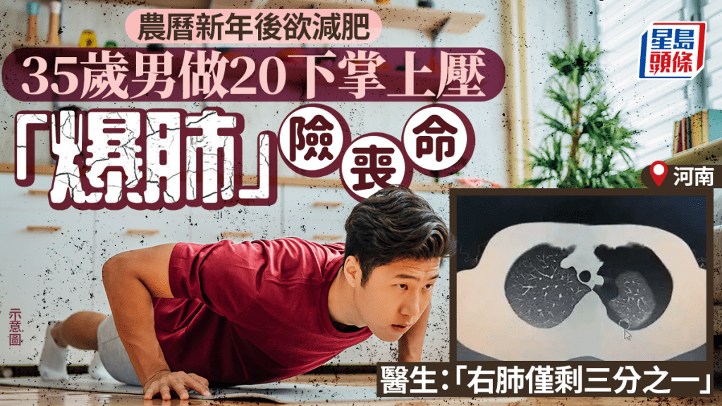 減肥出事|35歲男做20掌上壓「爆肺」 確診為自發性氣胸險喪命