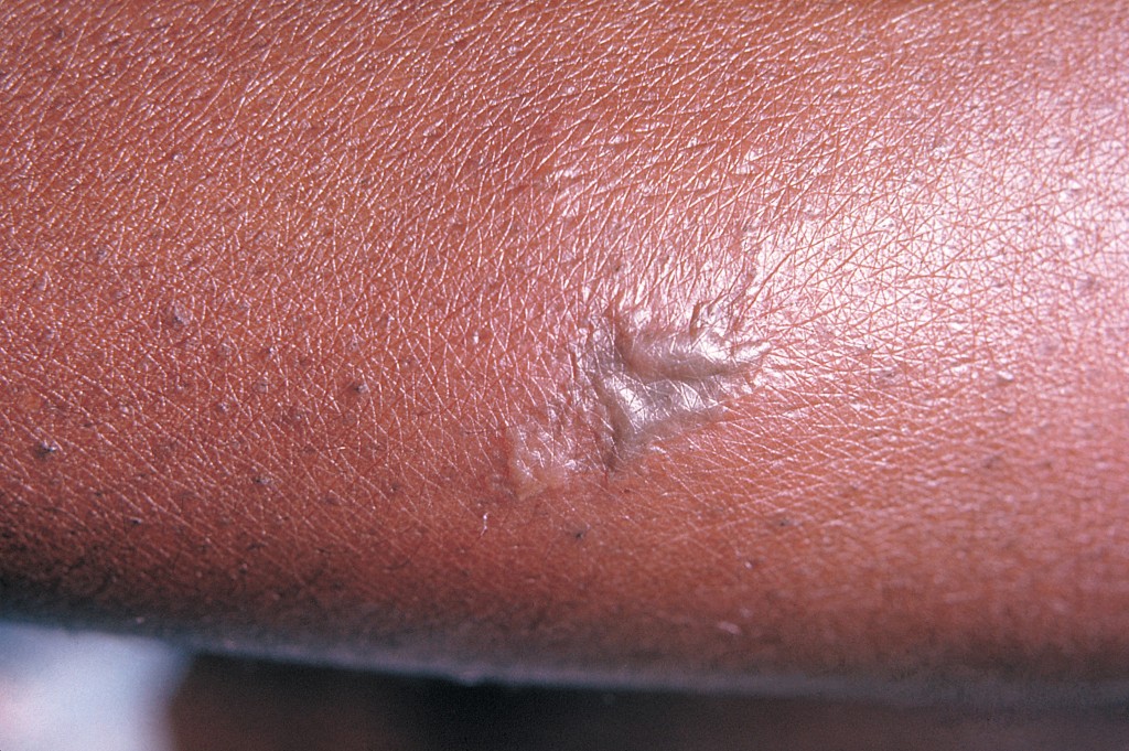 淋病的皮膚病徵。 Wiki