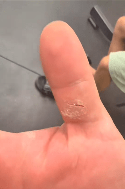 若皮肤有伤口，必须用防水创可贴妥善包扎，否则容易感染。