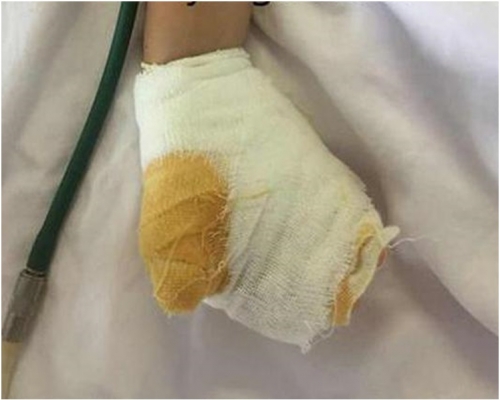 醫生指女童左手損傷非常嚴重。網圖