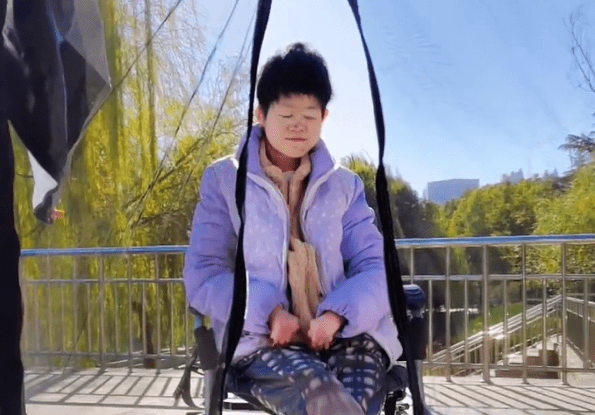 15年間,高尚好共接受5次分指手術。 15年間,高尚好共接受5次分指手術。