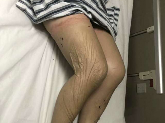 其中一人因穿丝袜，伤情较严重。 网图