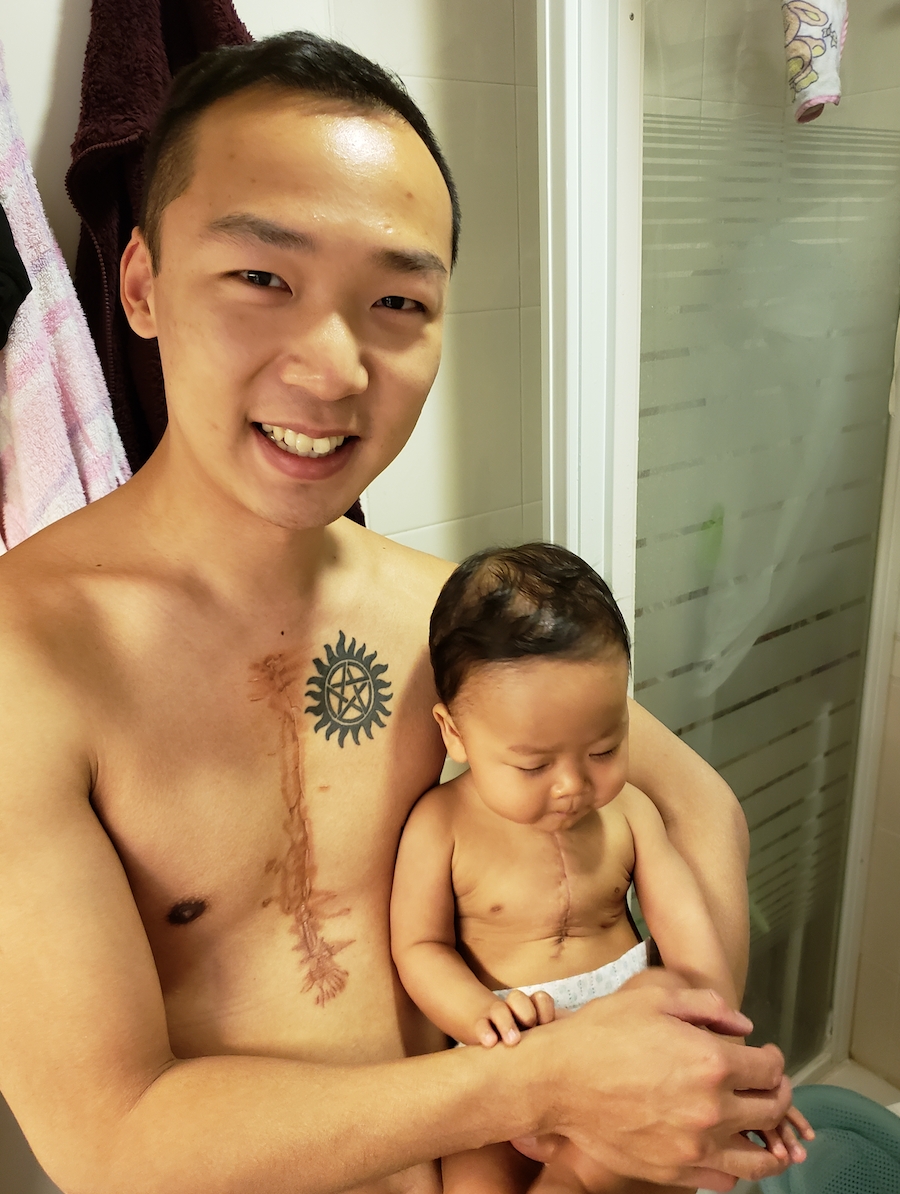 爸爸紋下與兒子相同的手術疤痕紋身。 小鐵漢媽媽facebook圖片