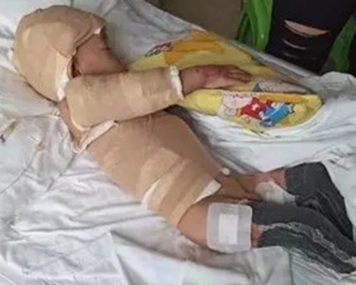 王福星全身四成皮膚遭燒傷。網上圖片