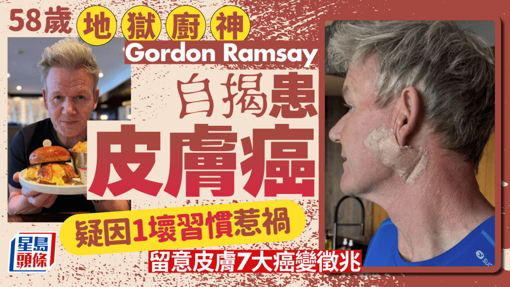 58歲地獄廚神Gordon Ramsay自爆患皮膚癌 疑因1壞習慣惹禍 留意皮膚7大癌變徵兆